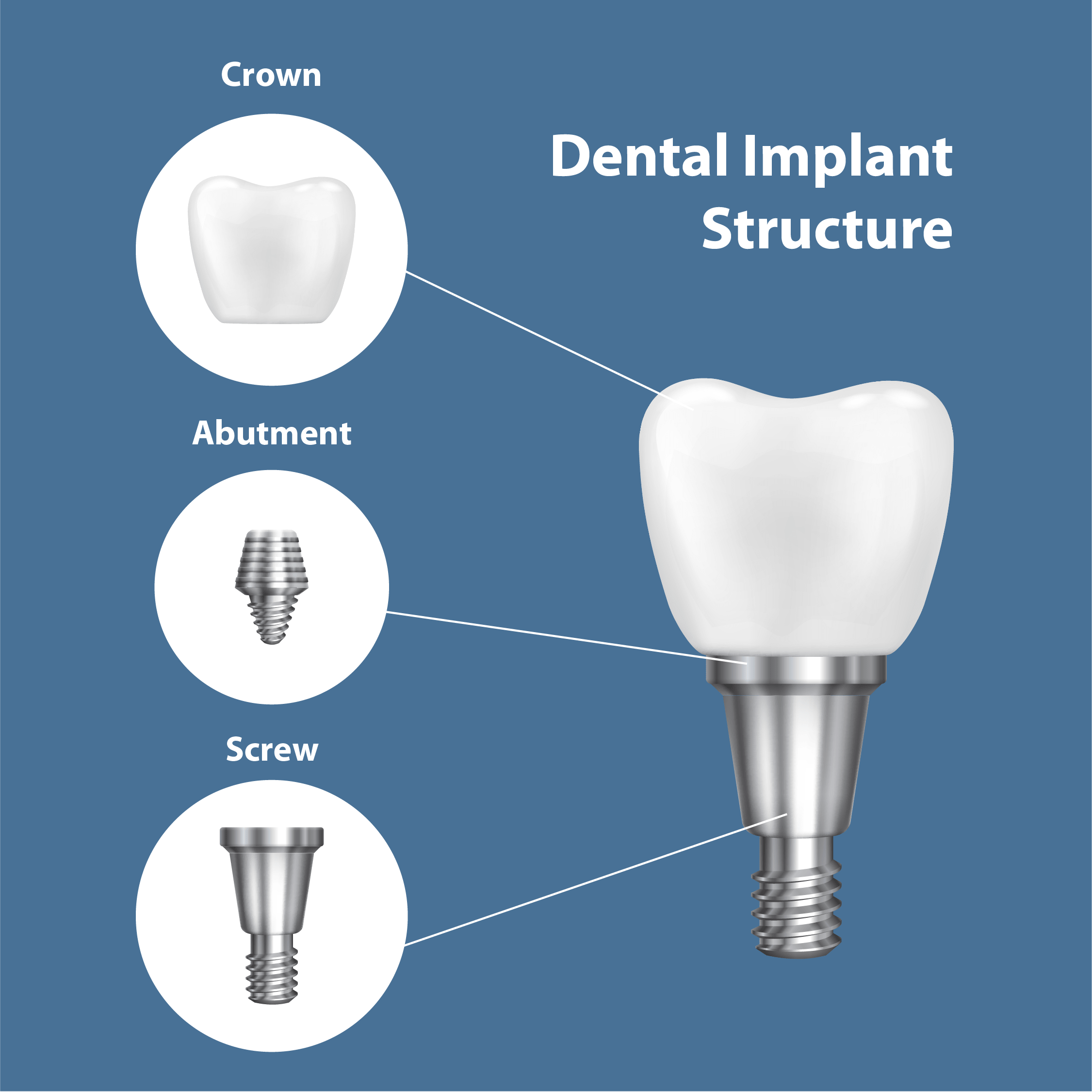 dental-implant-structure